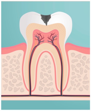 Carie dentaire niveau 2